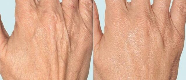 Piel de la mano antes y después de la terapia fraccionada.