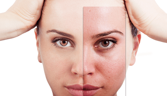 El rejuvenecimiento fraccionado elimina las principales imperfecciones estéticas del rostro