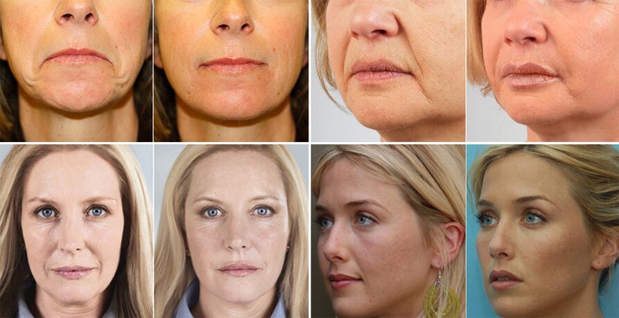 Fotos de mujeres antes y después del rejuvenecimiento de la piel del rostro. 